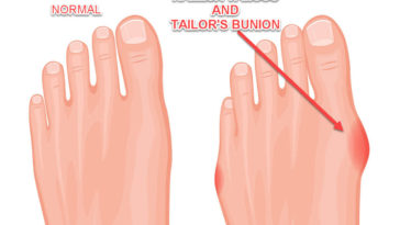 Get Rid Of Hallux Valgus
