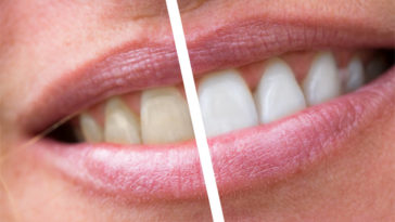 Teeth Before After Treatment